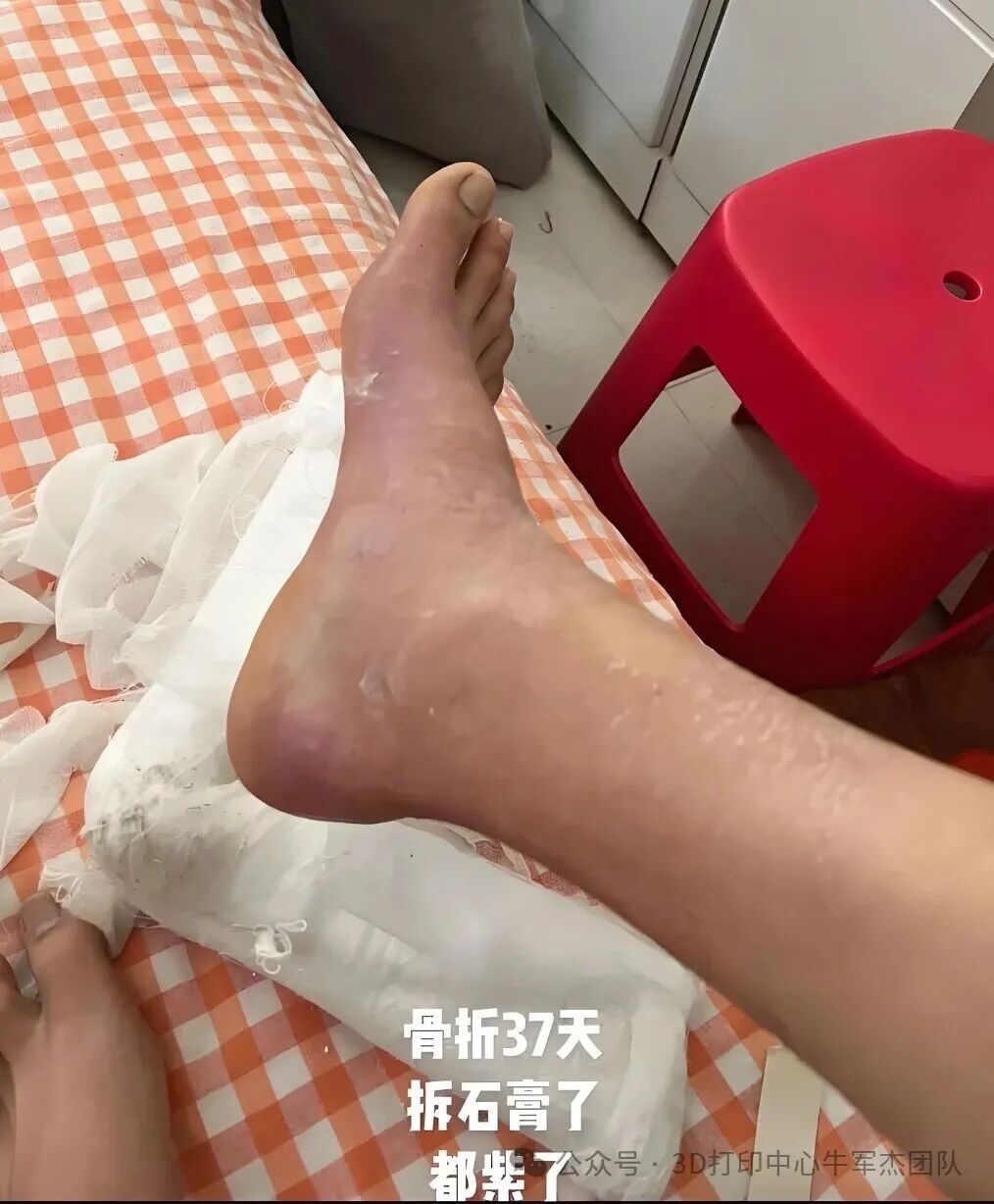 Goodbye to Heavy Plaster: Instant 3D Printing for Precise Orthopedic Rehabilitation!