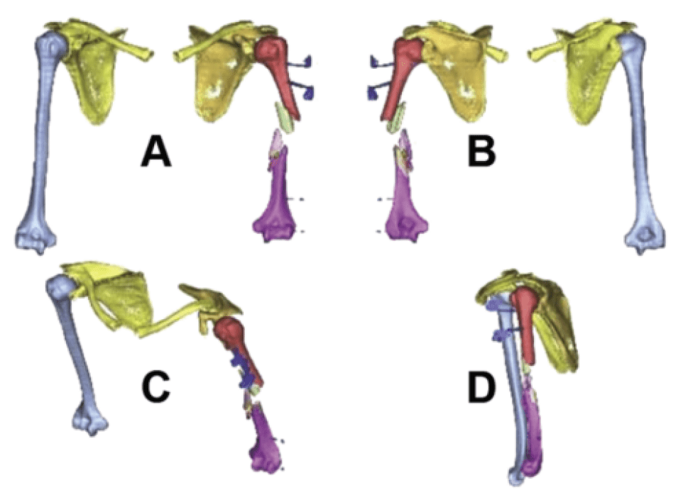 3D Printing of PEEK (Polyether Ether Ketone) for Treating Humeral Fractures Caused by Gunshot Wounds in the Russia-Ukraine War
