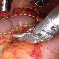 Robotic Ileal Ureter Replacement: Addressing Severe Ureteral Strictures