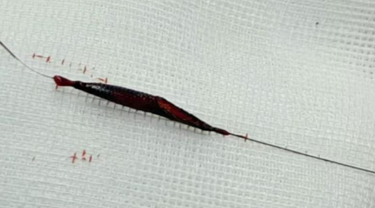 Application of the C-Balloon® Catheter Combined with the PathGuard® Umbrella for Endovascular Treatment of Floating Thrombus at the Carotid Artery Bifurcation