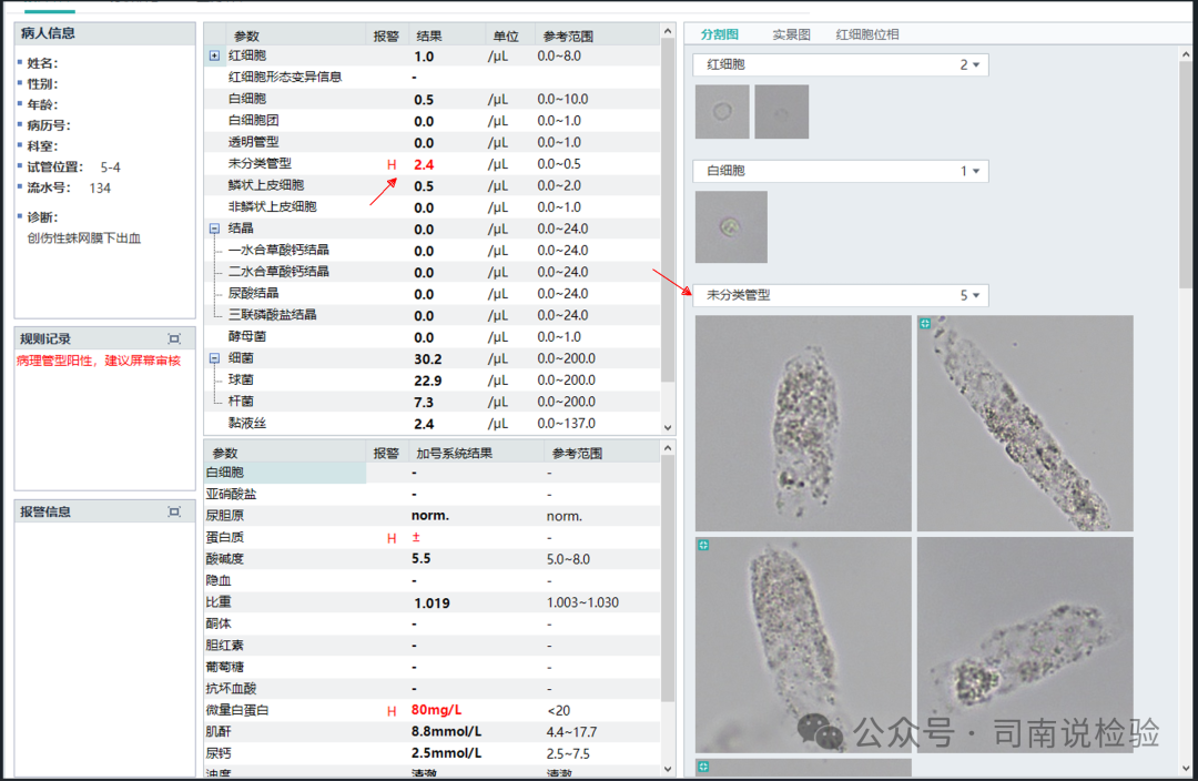 Morphology 127: Urine - Granular Casts (Instrument-Assisted Diagnosis)