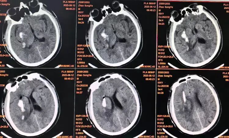 How 3D Printing Enables One-Click Customization of Minimally Invasive Hemorrhage Solutions