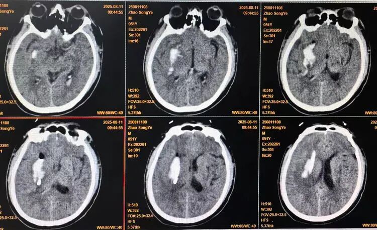How 3D Printing Enables One-Click Customization of Minimally Invasive Hemorrhage Solutions