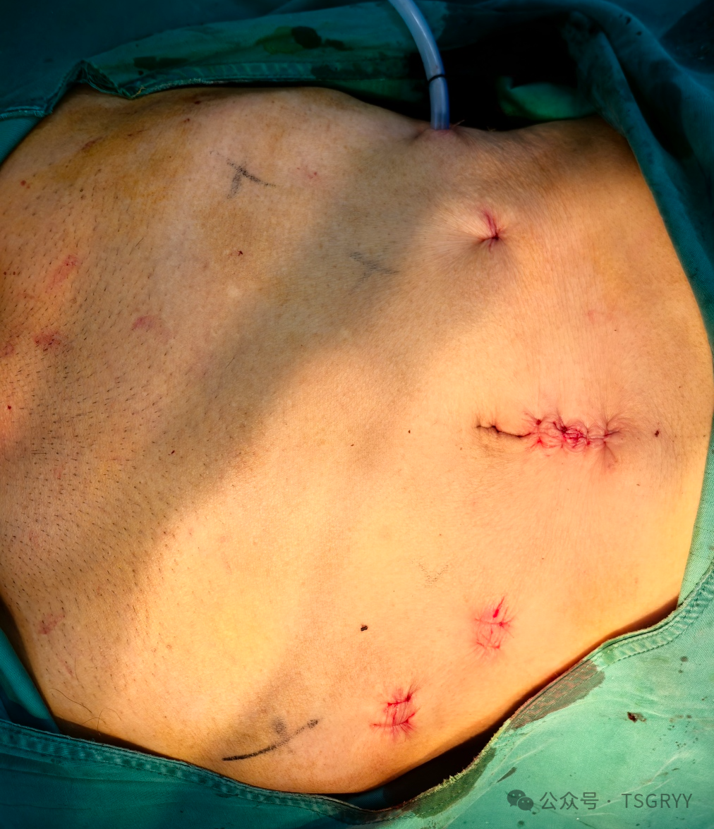 Precision Minimally Invasive Surgery: Safeguarding Life's Glands