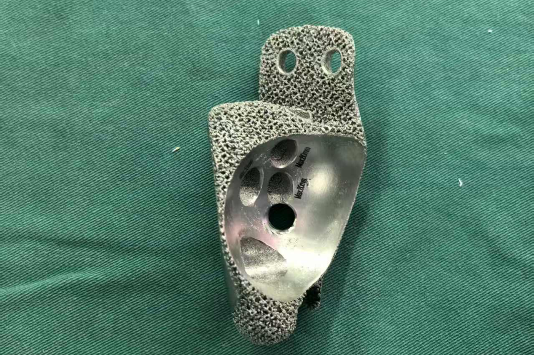 First in the County! Successful Reconstruction of Hip Joint Revision Surgery Using Titanium Alloy 3D Printed Pelvic Prosthesis at Tonglu County Traditional Chinese Medicine Hospital