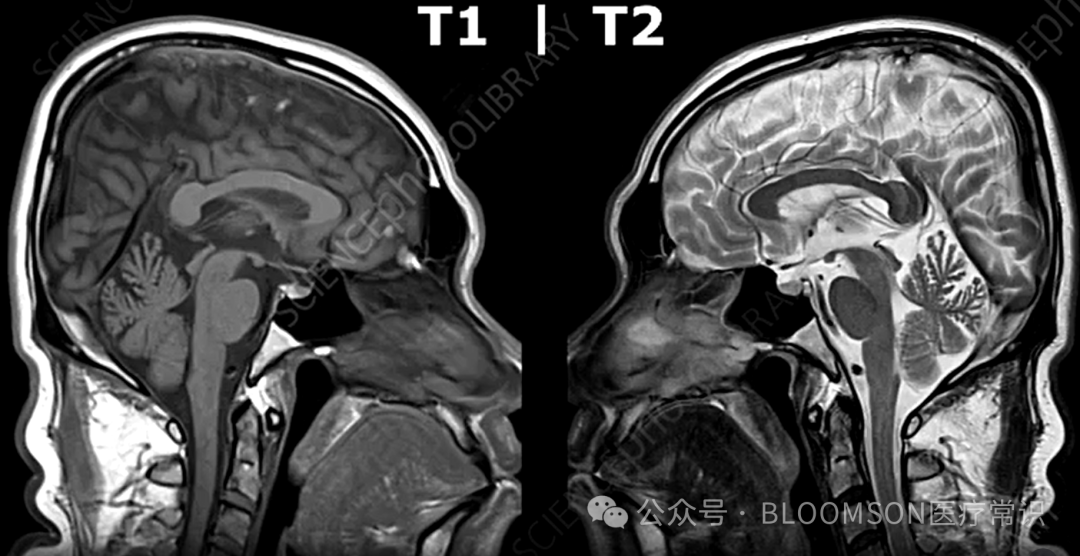 Overview of DWI and ADC Values in MRI