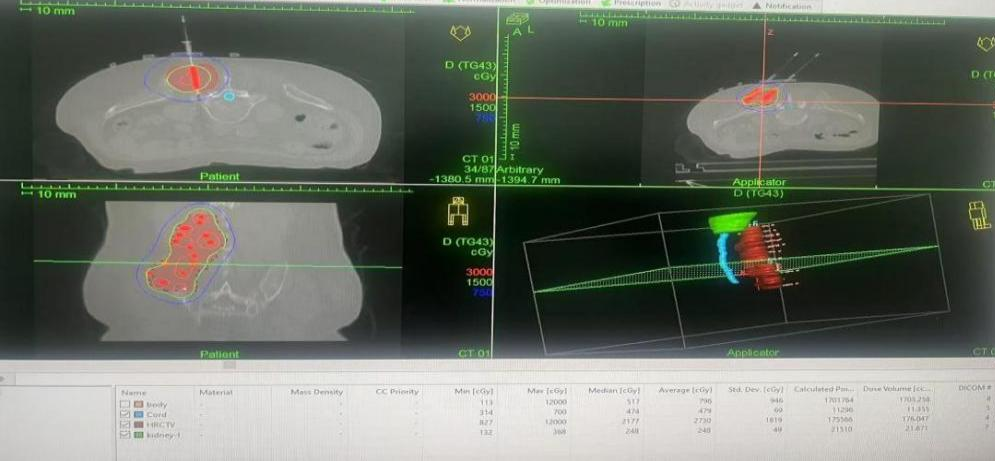 3D Printing Precision Guidance for Large Segment Implant Radiation Therapy Successfully Targets Complex Uterine Sarcoma Metastases