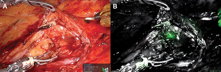 Robotic Ileal Ureter Replacement: Addressing Severe Ureteral Strictures