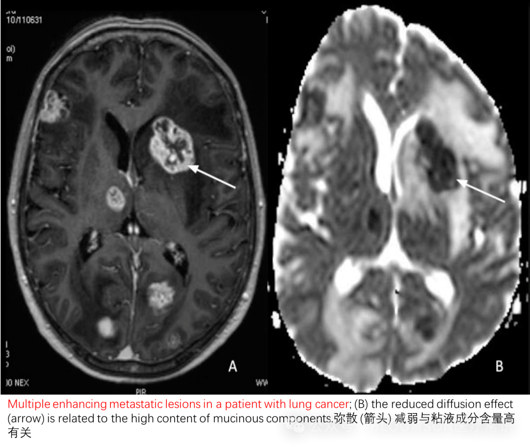 Overview of DWI and ADC Values in MRI