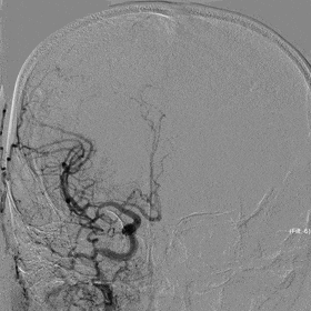Application of the C-Balloon® Catheter Combined with the PathGuard® Umbrella for Endovascular Treatment of Floating Thrombus at the Carotid Artery Bifurcation