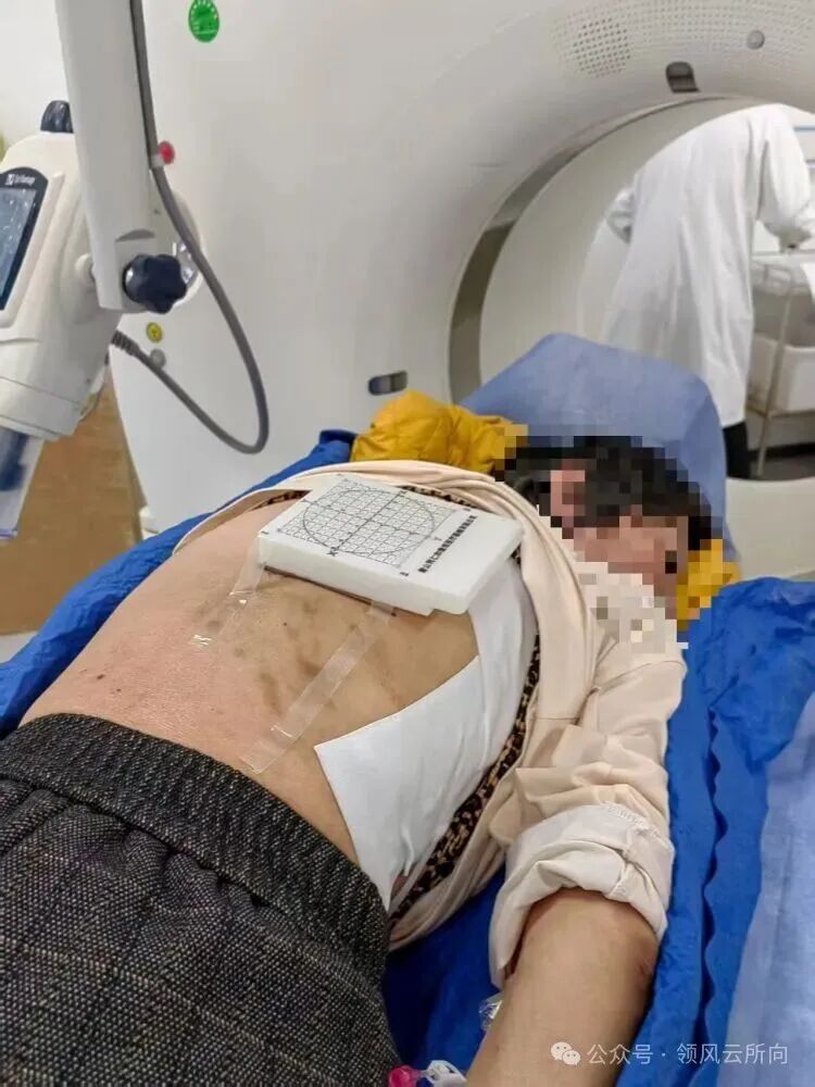 Minimally Invasive Tumor Techniques Series - 3D Printed Coplanar Template-Assisted Radioactive Particle Implantation