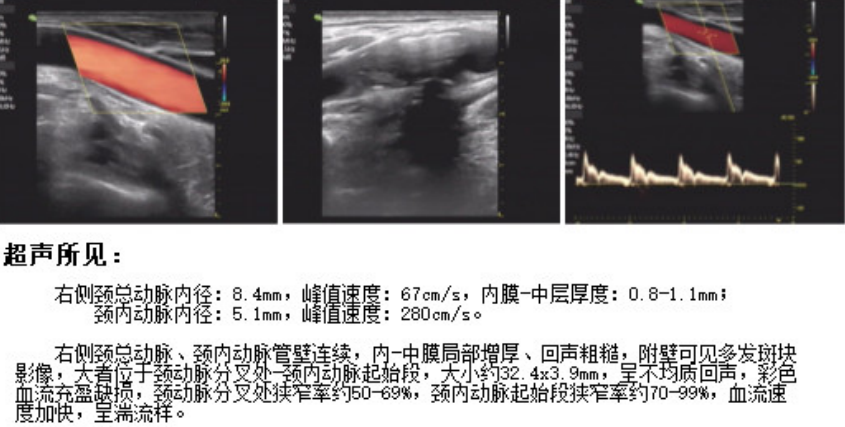 Application of the C-Balloon® Catheter Combined with the PathGuard® Umbrella for Endovascular Treatment of Floating Thrombus at the Carotid Artery Bifurcation