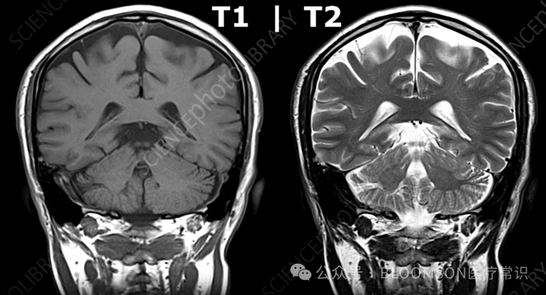 Overview of DWI and ADC Values in MRI