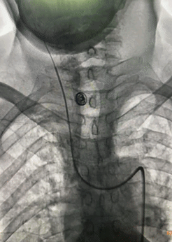 Application of the C-Balloon® Catheter Combined with the PathGuard® Umbrella for Endovascular Treatment of Floating Thrombus at the Carotid Artery Bifurcation