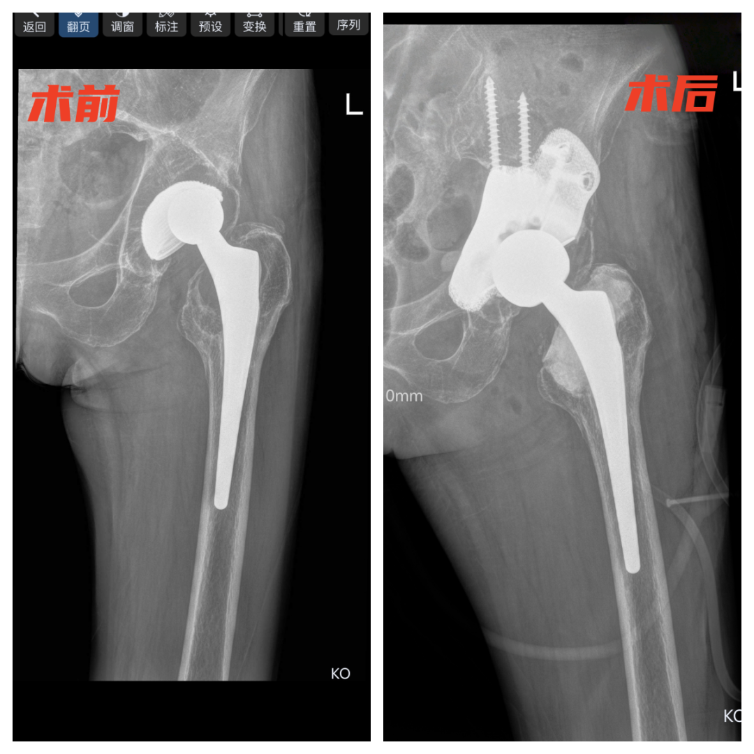 First in the County! Successful Reconstruction of Hip Joint Revision Surgery Using Titanium Alloy 3D Printed Pelvic Prosthesis at Tonglu County Traditional Chinese Medicine Hospital
