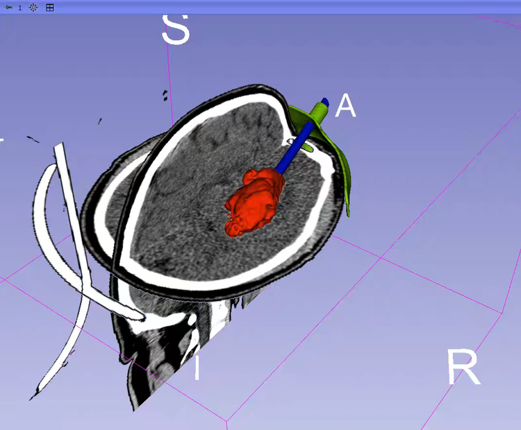 How 3D Printing Enables One-Click Customization of Minimally Invasive Hemorrhage Solutions