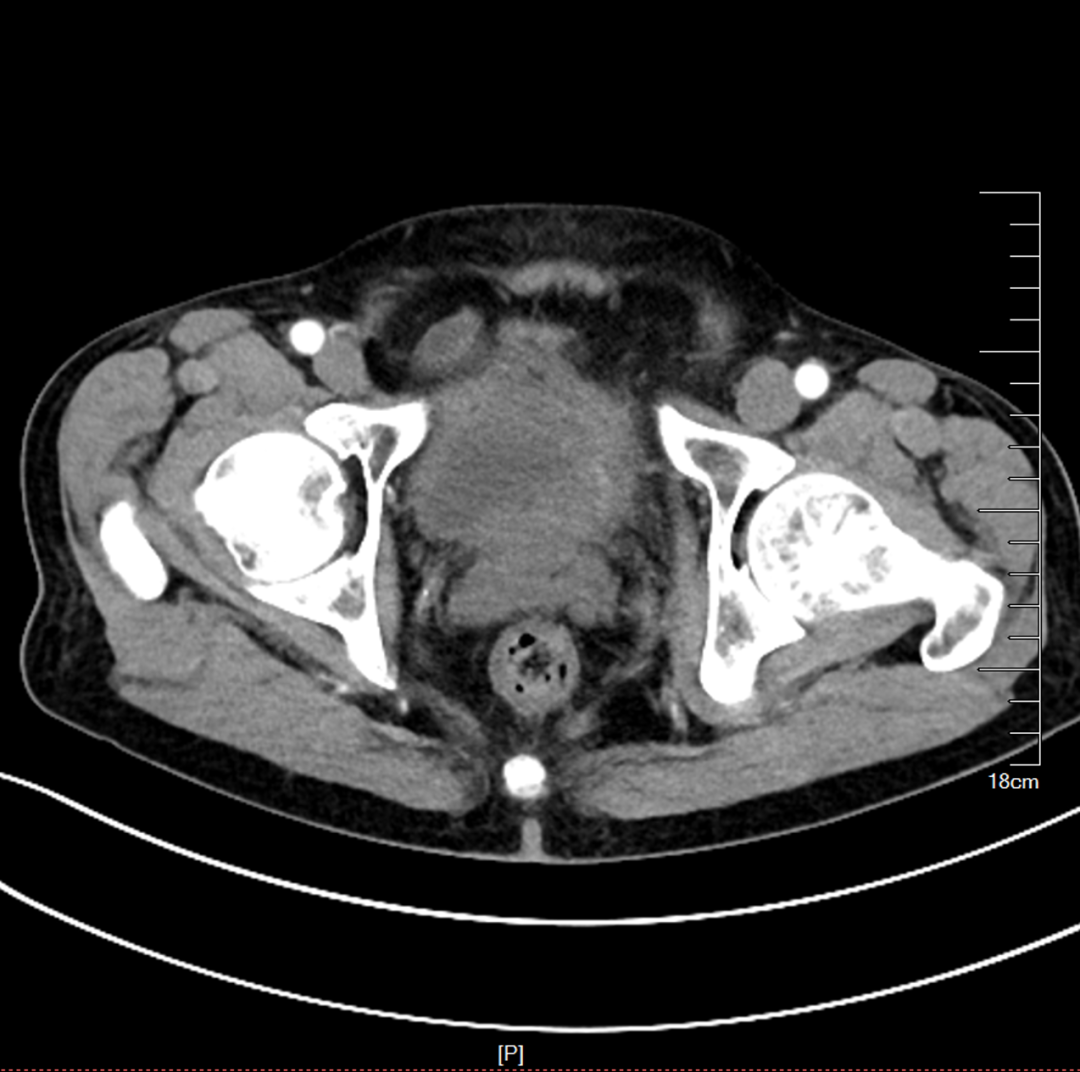 Application of ADC Drugs in Organ Preservation for High-Risk Non-Muscle Invasive Urothelial Carcinoma Patients
