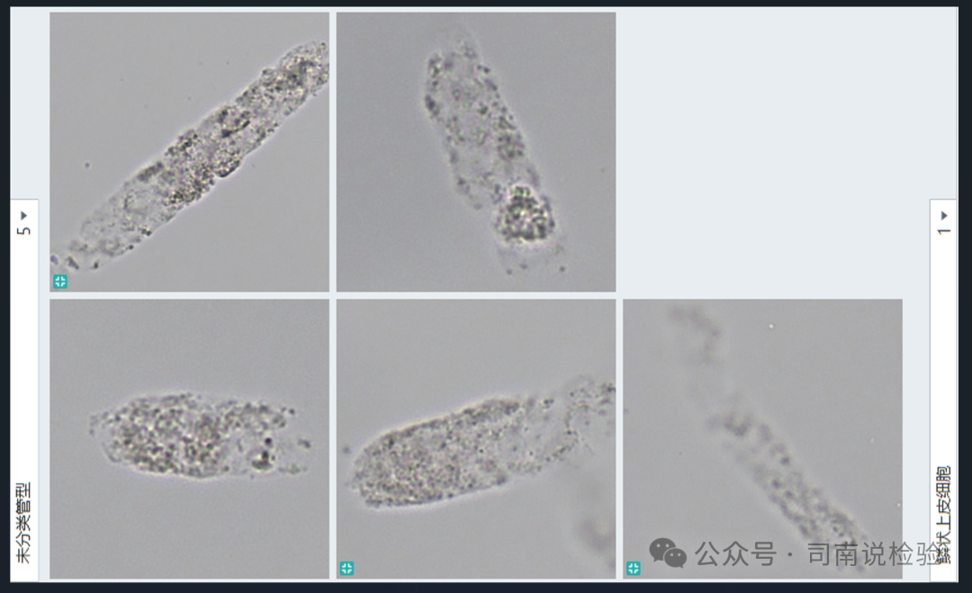 Morphology 127: Urine - Granular Casts (Instrument-Assisted Diagnosis)