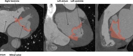 Integrating Multimodal Imaging (TEE and CT) and 3D Printing Technology to Create Patient-Specific Models for Optimizing Mitral Valve Interventions