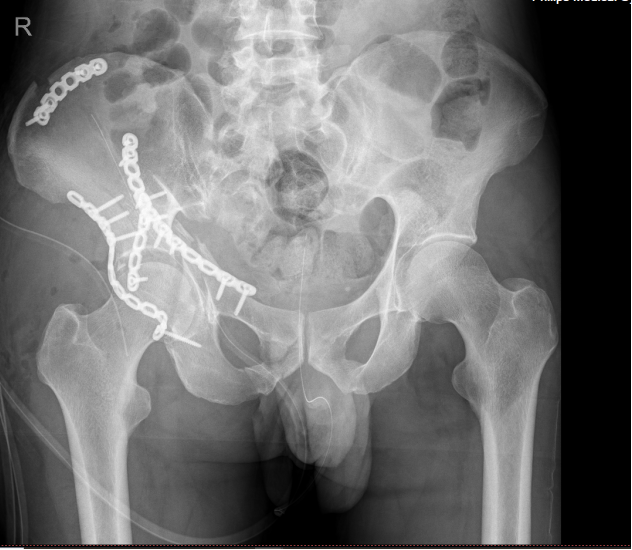 Successful Treatment of a Pelvic and Acetabular Fracture Patient Using 3D Printing Technology at Nanjing Traditional Chinese Medicine Hospital