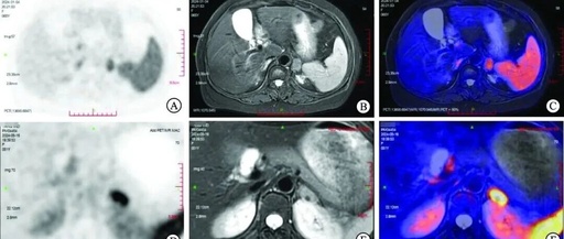 Case Report: Contradictory Results of CXCR4 Imaging and Adrenal Vein Sampling in Two Cases