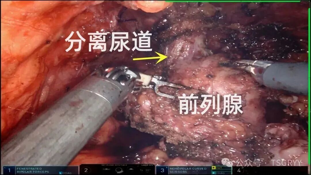 Precision Minimally Invasive Surgery: Safeguarding Life's Glands