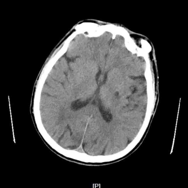 Application of the C-Balloon® Catheter Combined with the PathGuard® Umbrella for Endovascular Treatment of Floating Thrombus at the Carotid Artery Bifurcation