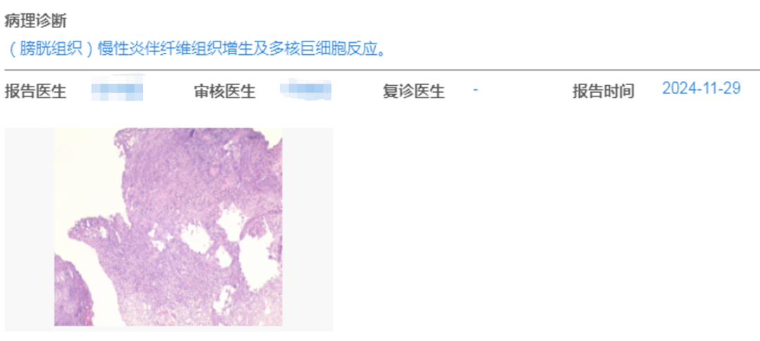 Application of ADC Drugs in Organ Preservation for High-Risk Non-Muscle Invasive Urothelial Carcinoma Patients