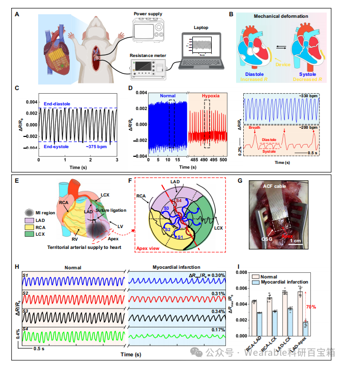 Electronic Tattoos for the Heart: Biodegradable Strain Sensors for Real-Time Detection of Myocardial Infarction