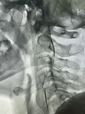 Application of the C-Balloon® Catheter Combined with the PathGuard® Umbrella for Endovascular Treatment of Floating Thrombus at the Carotid Artery Bifurcation