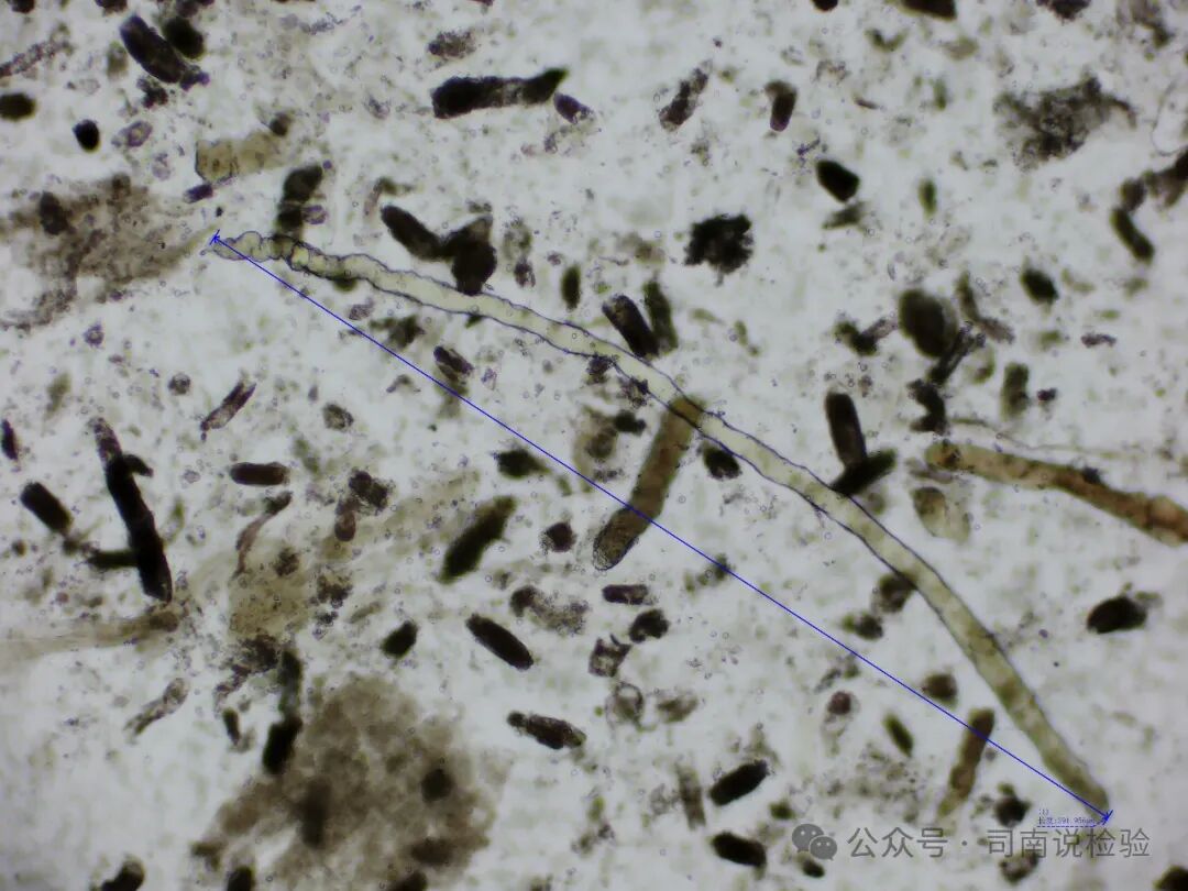 Morphology 127: Urine - Granular Casts (Instrument-Assisted Diagnosis)