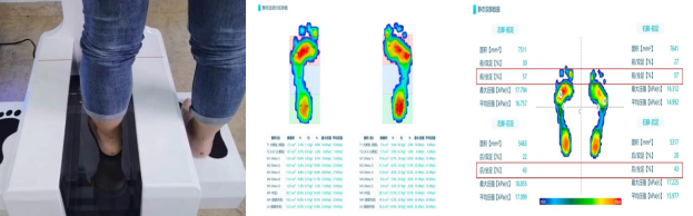 Customizing Foot Arches: The Revolution of 3D Printing