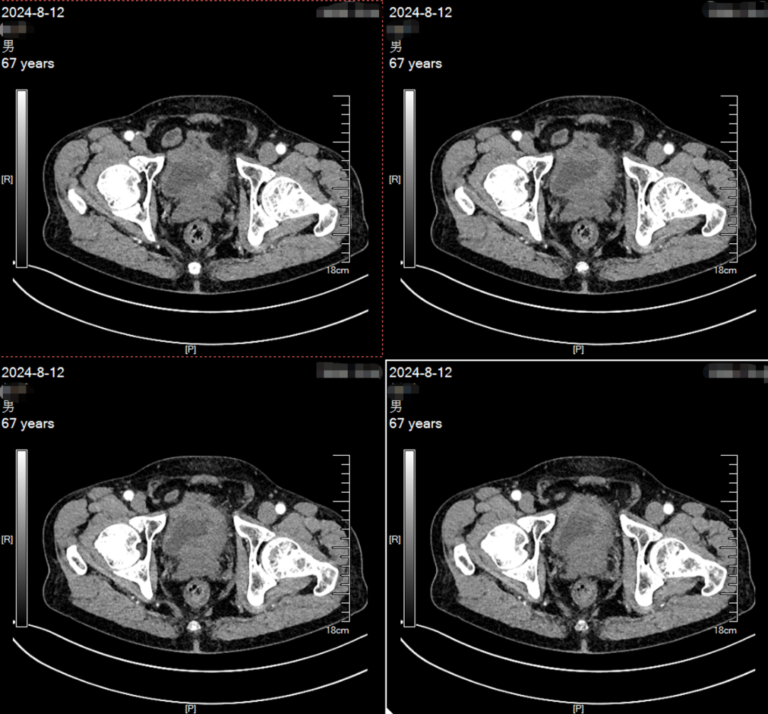 Application of ADC Drugs in Organ Preservation for High-Risk Non-Muscle Invasive Urothelial Carcinoma Patients
