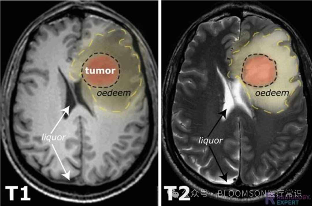 Overview of DWI and ADC Values in MRI