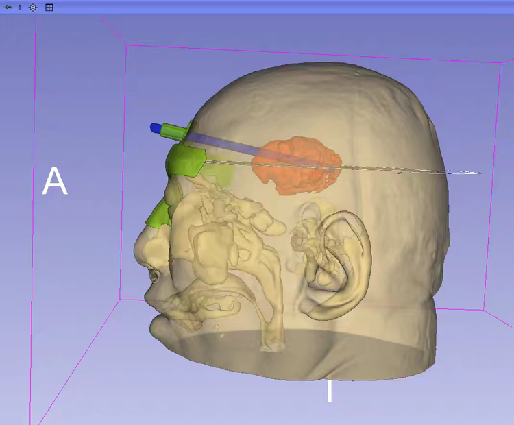 How 3D Printing Enables One-Click Customization of Minimally Invasive Hemorrhage Solutions