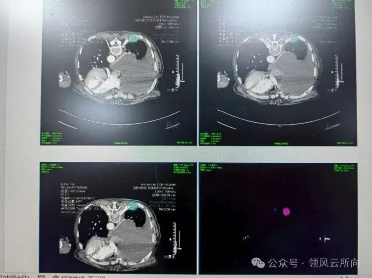 Minimally Invasive Tumor Techniques Series - 3D Printed Coplanar Template-Assisted Radioactive Particle Implantation