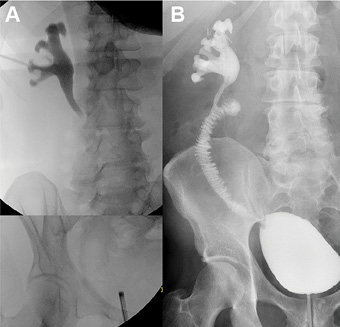 Robotic Ileal Ureter Replacement: Addressing Severe Ureteral Strictures