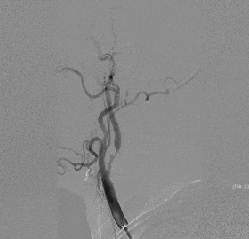 Application of the C-Balloon® Catheter Combined with the PathGuard® Umbrella for Endovascular Treatment of Floating Thrombus at the Carotid Artery Bifurcation