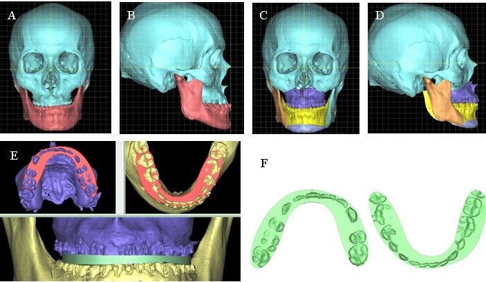 Digital Design and 3D Printing Technology in the Treatment of Malocclusion