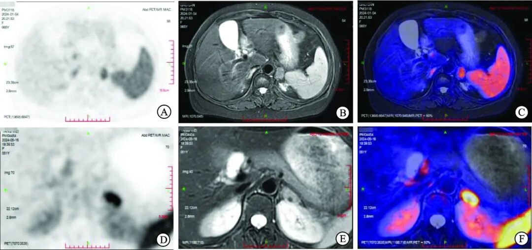 Case Report: Contradictory Results of CXCR4 Imaging and Adrenal Vein Sampling in Two Cases