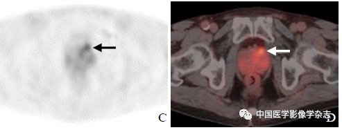 The Value of miPSMA Scoring in Diagnosing Prostate Cancer Using (68)Ga-PSMA-11 PET/CT Imaging