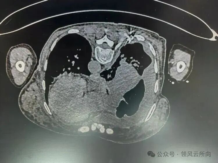 Minimally Invasive Tumor Techniques Series - 3D Printed Coplanar Template-Assisted Radioactive Particle Implantation