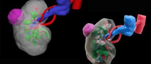 3D Printing of Kidney Tumors Could Transform Kidney Cancer Research
