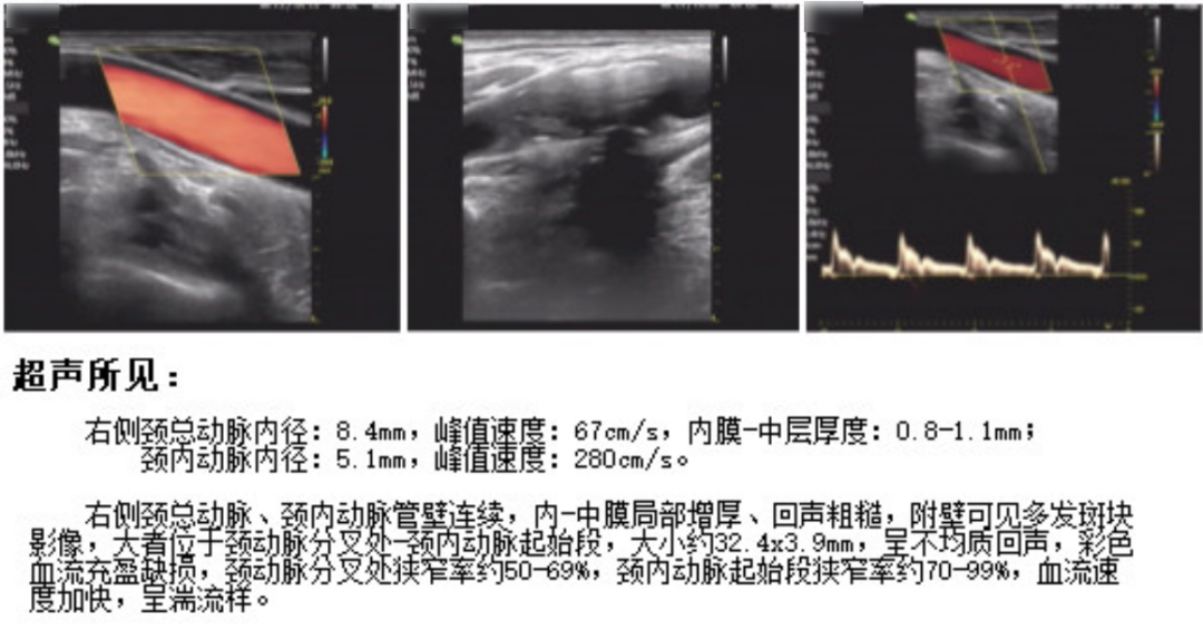 Application of the C-Balloon® Catheter Combined with the PathGuard® Umbrella for Endovascular Treatment of Floating Thrombus at the Carotid Artery Bifurcation
