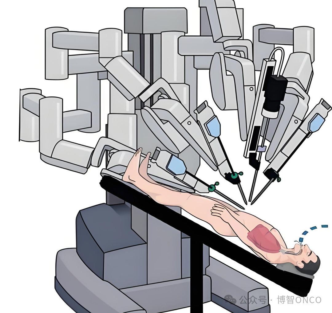 New Frontiers in Minimally Invasive Surgery: Exploration and Future of Robot-Assisted Single-Port Laparoscopic Radical Prostatectomy