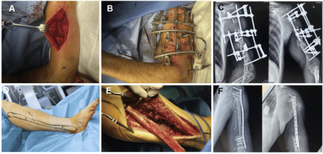 3D Printing of PEEK (Polyether Ether Ketone) for Treating Humeral Fractures Caused by Gunshot Wounds in the Russia-Ukraine War