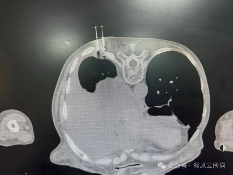 Minimally Invasive Tumor Techniques Series - 3D Printed Coplanar Template-Assisted Radioactive Particle Implantation