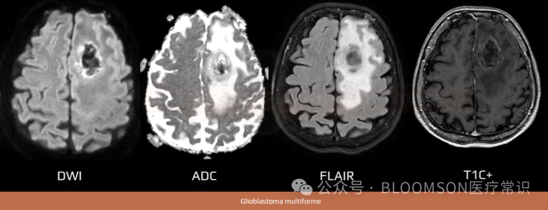 Overview of DWI and ADC Values in MRI