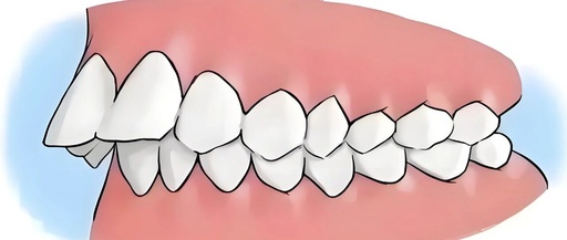 Digital Design and 3D Printing Technology in the Treatment of Malocclusion