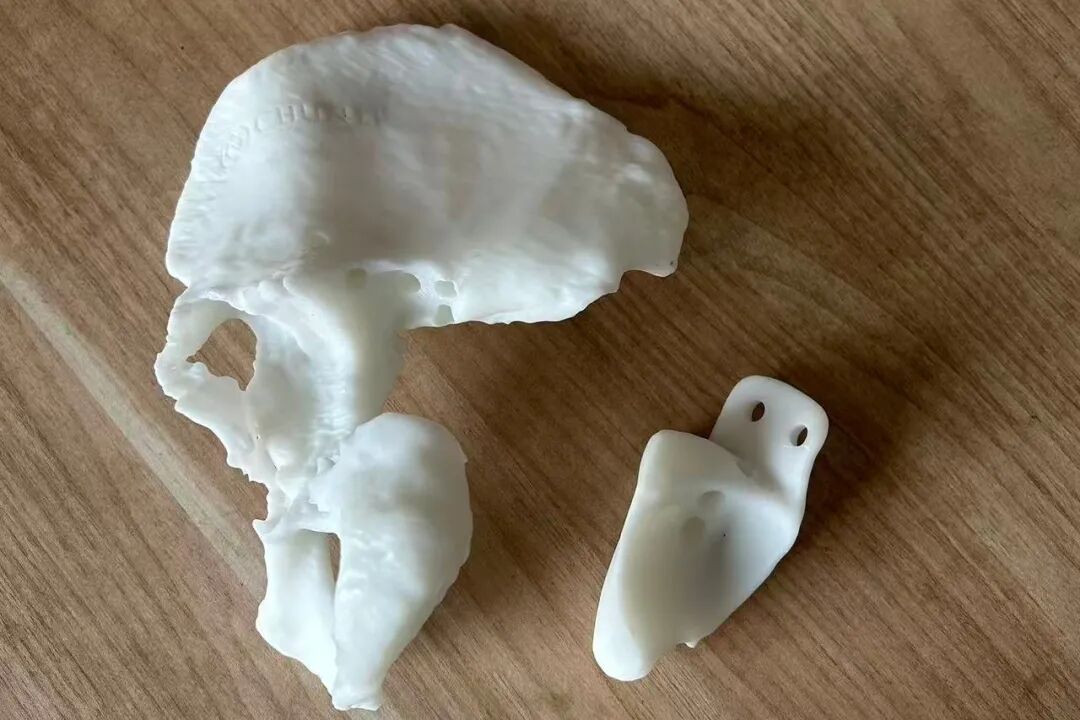 First in the County! Successful Reconstruction of Hip Joint Revision Surgery Using Titanium Alloy 3D Printed Pelvic Prosthesis at Tonglu County Traditional Chinese Medicine Hospital